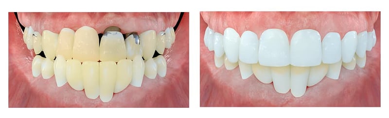 2024-11 - Full-arch maxillary FP1 rehabilitation - David Lara 03