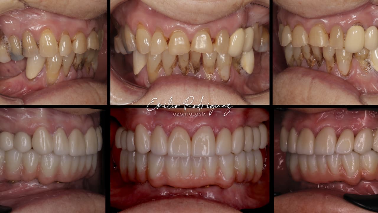 2025-02 - Bimaxillary rehabilitation periodontal disease bone atrophy - 1 