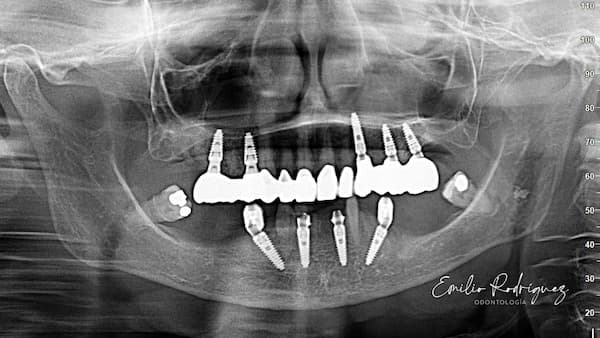 2025-02 - Bimaxillary rehabilitation periodontal disease bone atrophy - 14