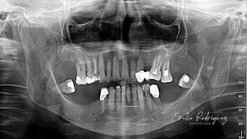 2025-02 - Bimaxillary rehabilitation periodontal disease bone atrophy - 3