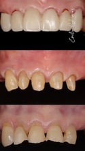 2025-02 - Bimaxillary rehabilitation periodontal disease bone atrophy -13