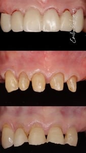 2025-02 - Bimaxillary rehabilitation periodontal disease bone atrophy -13