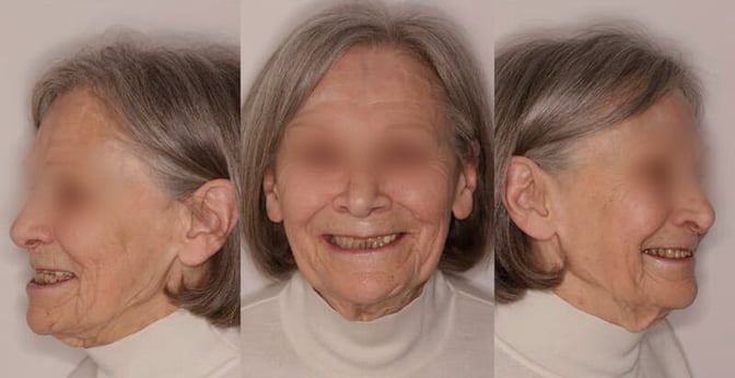 2025-02 - Bimaxillary rehabilitation periodontal disease bone atrophy -2