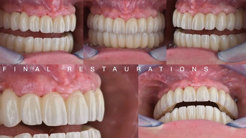 2025-05 - Full rehabilitation inflammation low density bone Cojocaru