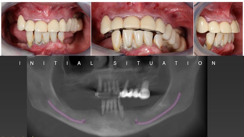 2025-05 - Full rehabilitation inflammation low density bone Cojocaru - 2