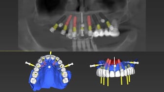 2025-05 - Full rehabilitation inflammation low density bone Cojocaru - 4
