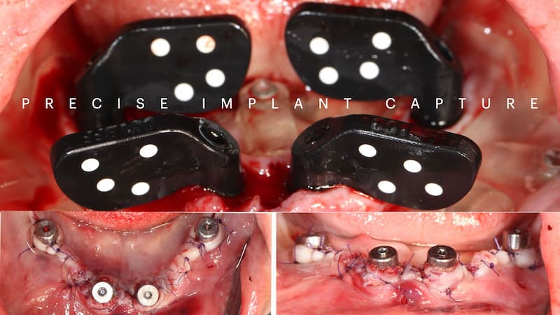 2025-05 - Full rehabilitation inflammation low density bone Cojocaru - 7