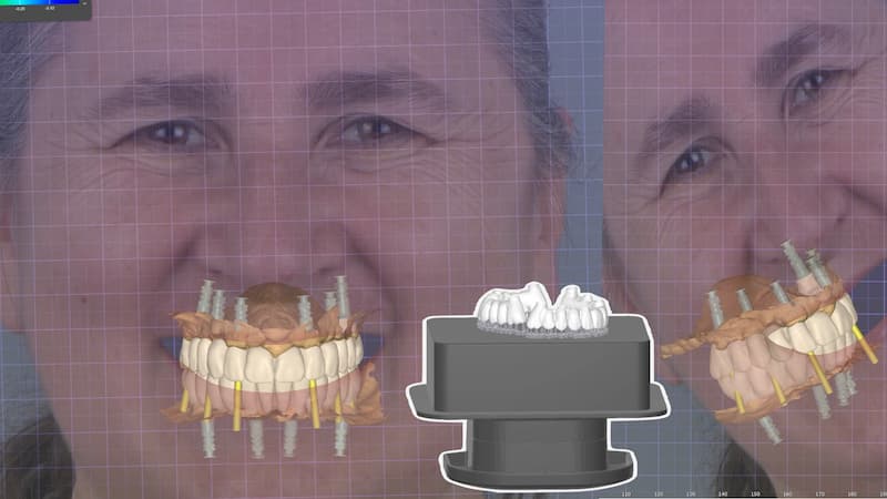 2025-05 - Full rehabilitation inflammation low density bone Cojocaru - 8