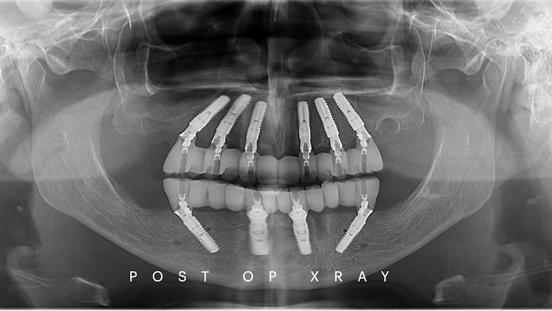 2025-05 - Full rehabilitation inflammation low density bone Cojocaru - 9