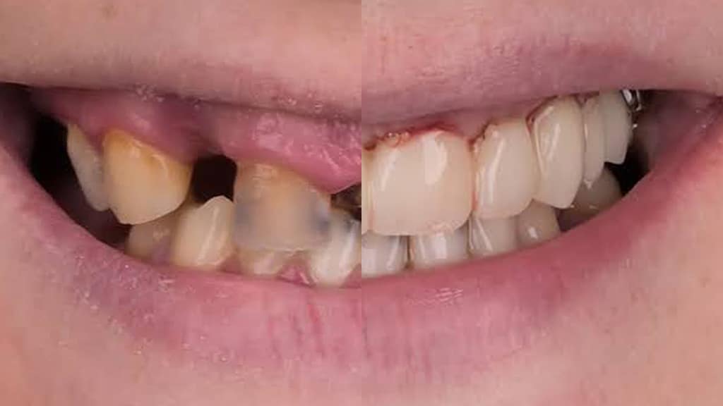 Full arch maxillary reconstruction in a single appointment