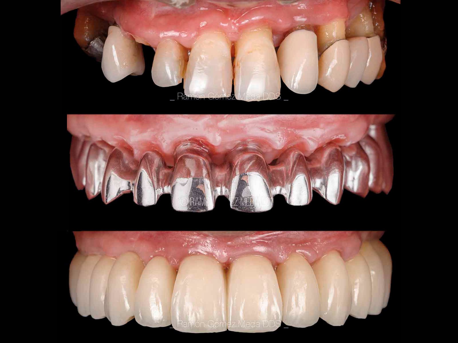 Rehabilitation of an advanced periodontal disease with a scalloped denture