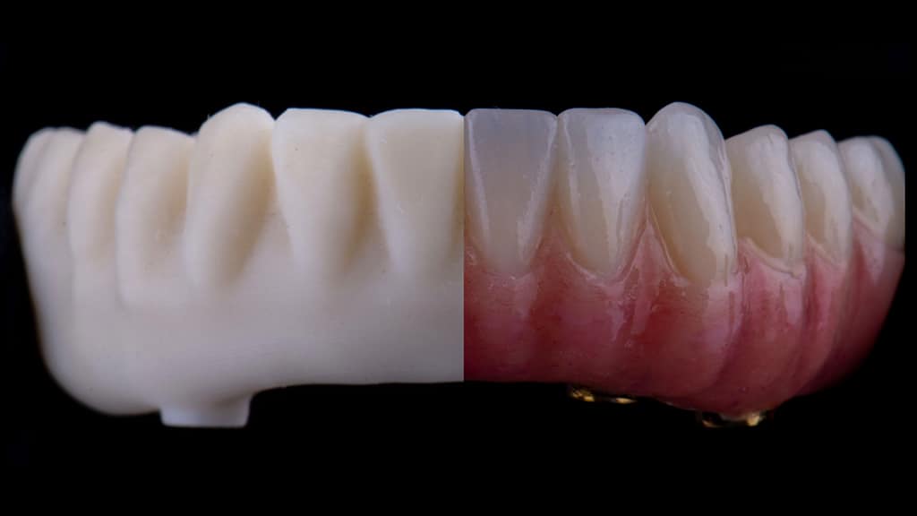 Severe bimaxillary bone deficiency solved with a double All-On-4