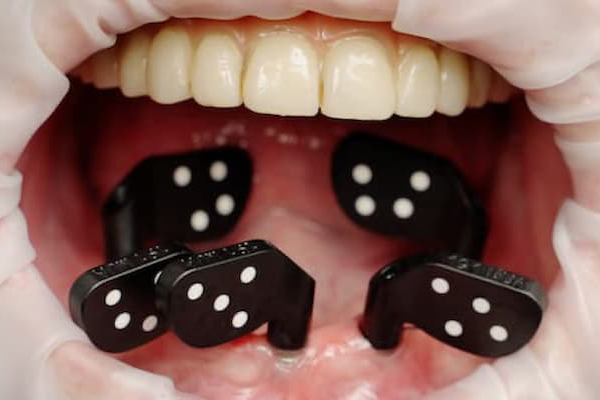PIC dental technique